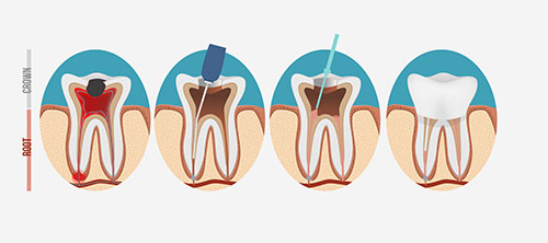 Root Canals Woodland Hills Dentist