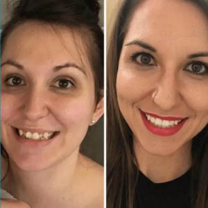 Invisalign Warner Center Cosmetic Dental Robert Sollow,DDS Before and After Invisalign Results