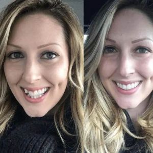 Invisalign Warner Center Cosmetic Dental Robert Sollow,DDS Before and After Invisalign Results